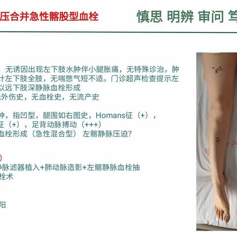 左髂静脉压迫合并髂股静脉血栓整体治疗方案案例分享