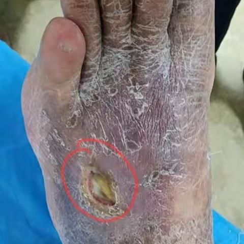 李彪，动脉合并静脉性溃疡