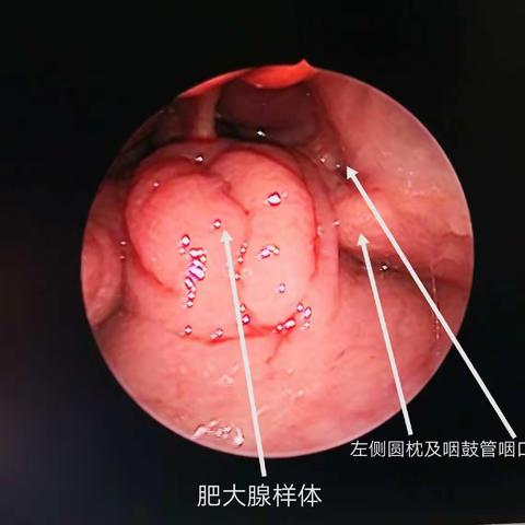 科普:腺样体肥大及低温等离子射频消融术