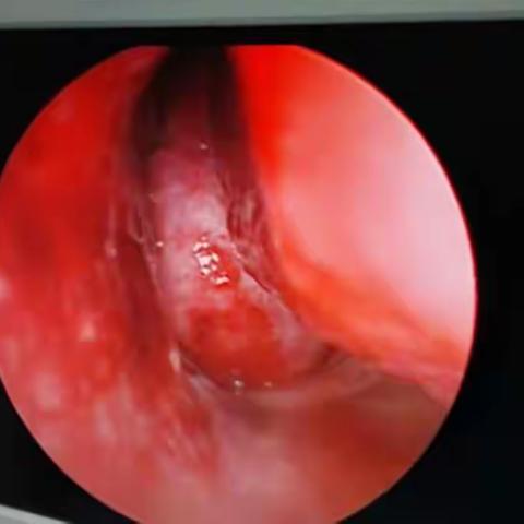 鼻内镜下鼻咽及鼻腔复杂性广基肿物切除术