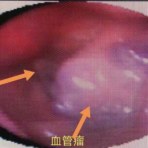 内镜辅助下支撑喉镜下下咽较大血管瘤切除术