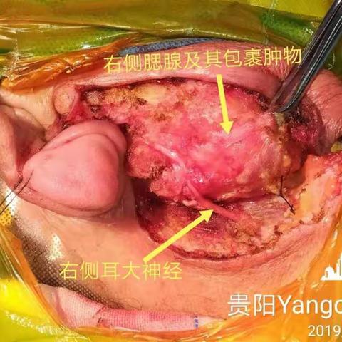 右侧腮腺混合瘤切除术