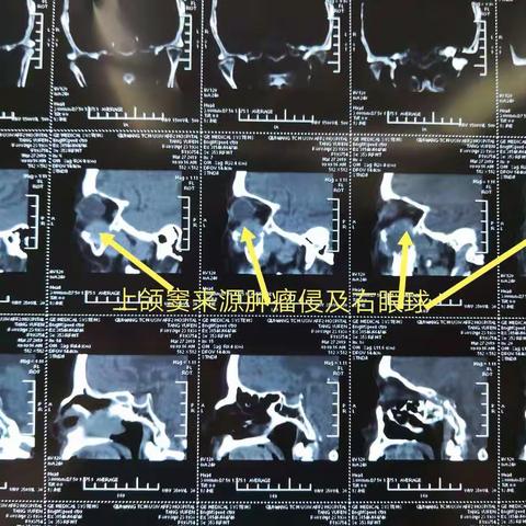 鼻内镜联合柯陆氏手术切除上颌窦来源广基肿瘤（已侵及右眼球、视神经、鼻腔、筛窦与蝶筛隐窝）