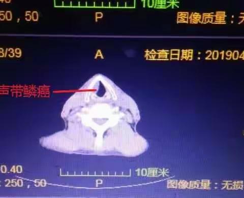 喉癌喉裂开声带切除术