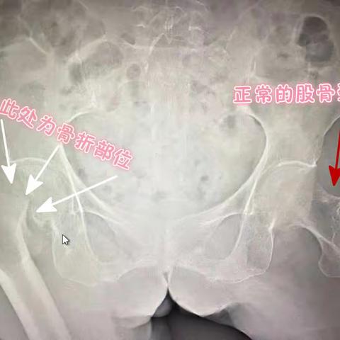 妙手回春，82岁患者重启人生路。