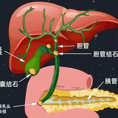 突发“节后腹痛”——胆结石患者需要时刻注意饮食