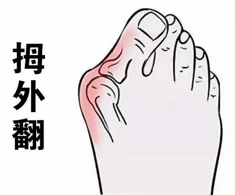 上海虹桥医院讲解：拇外翻的症状有哪些?