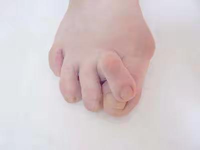拇外翻的症状 上海虹桥医院介绍