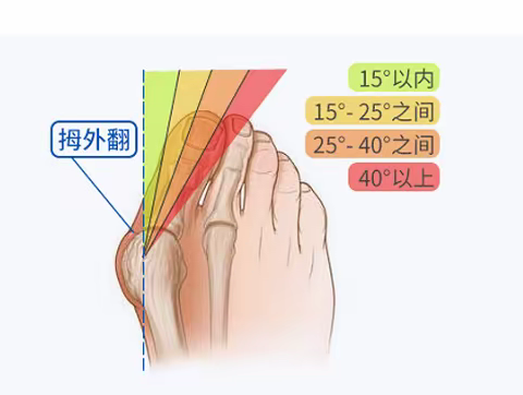 上海虹桥医院介绍：大脚骨的症状及诊断