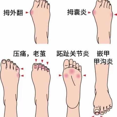 引起拇外翻的原因你肯定想不到!张树伟讲解