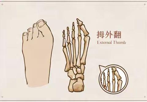 上海虹桥医院科普：拇外翻的预防