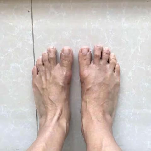 上海虹桥医院讲解：什么是大脚骨?