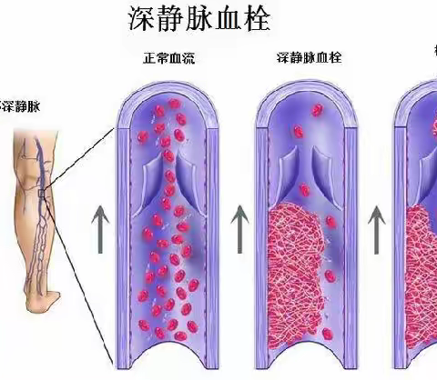 深静脉血栓能致命！如何预防看这篇