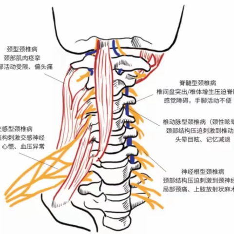 用“牵引治疗”治疗颈椎病有效吗？让我们一起走进“牵引治疗”的世界