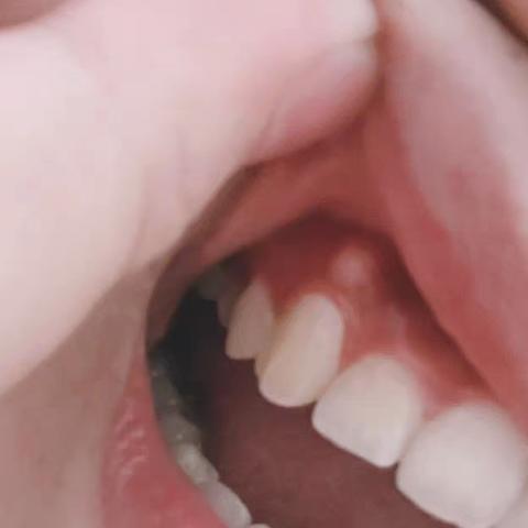 白术治疗骨溢（治疗骨刺、净根牙歪长疼痛）