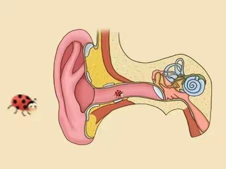 耳鼻喉科普之-外耳道异物