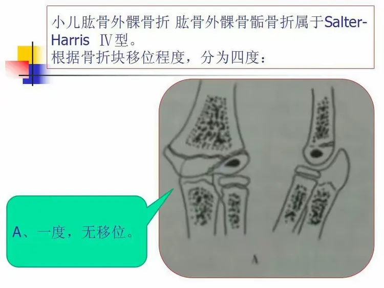【创伤篇】 010 儿童肱骨外髁骨折的治疗方法探讨（病例展示）
