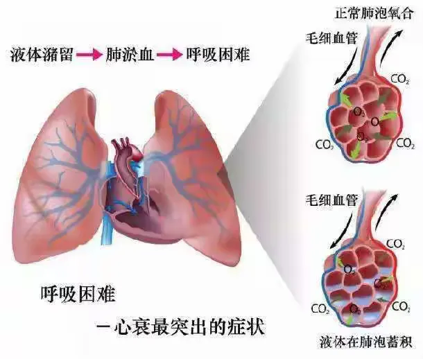 心力衰竭