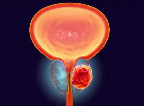靶向放射配体疗法Pluvicto有助于延缓PSMA阳性前列腺癌的进展