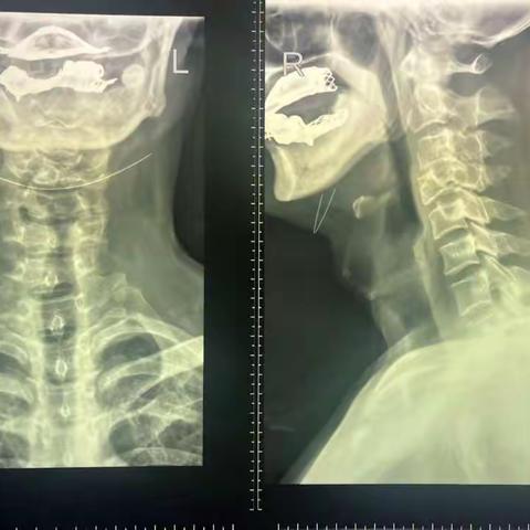 颈椎神经鞘瘤病例分享