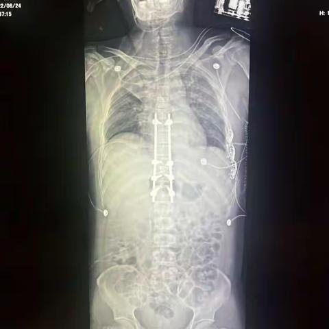 严重胸椎骨折脱位病例分享