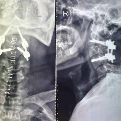 颈椎骨纤维异常增殖症手术治疗病例分享