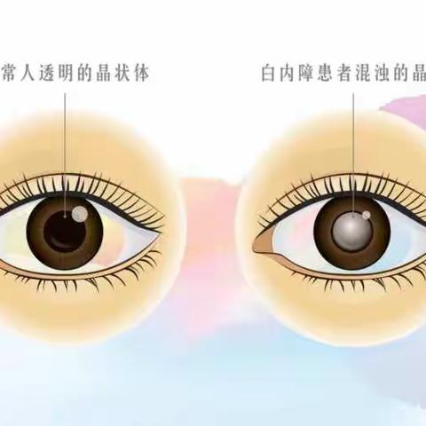 白内障“熟透了”才能手术吗？