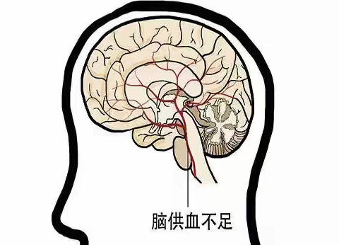 头晕就是“脑供血不足”？究竟如何鉴别与预防