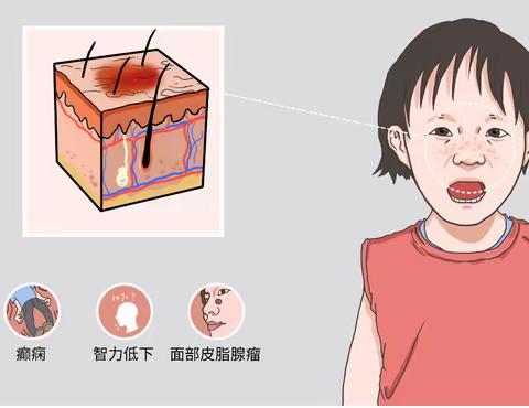 结节性硬化是怎么引起的