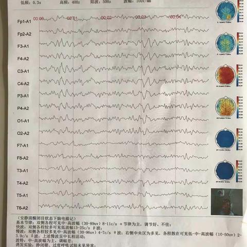 道县人民医院神经内科开展视频脑电图临床检测啦！