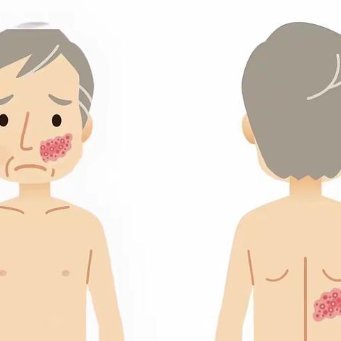 带状疱疹究竟有多恐怖？——被称为“不死的癌症”