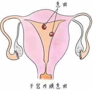 女性烦恼之子宫内膜息肉