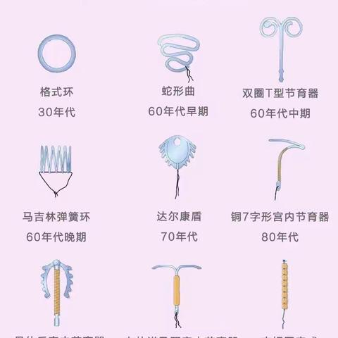 “调皮”的宫内节育器