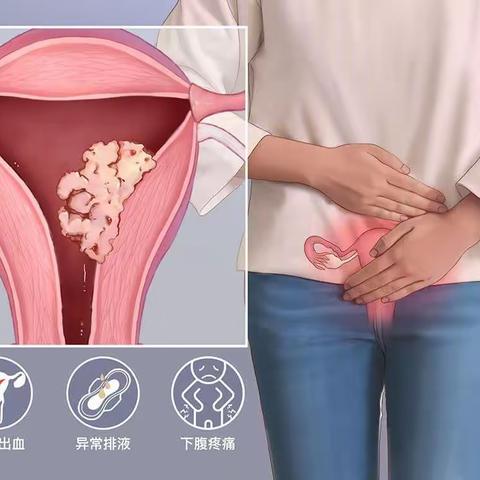 绝经后阴道流血，警惕子宫内膜癌