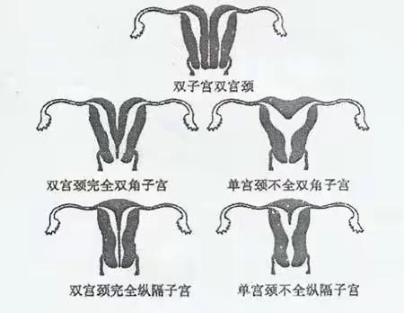 渭北中心医院完成首例腹腔镜下双子宫切除术