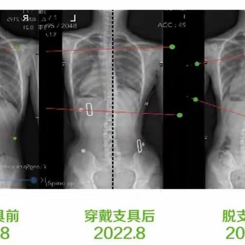 脊柱侧弯矫形器的效果跟踪案例