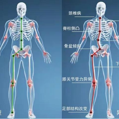 案例分享 几例定制矫形鞋垫矫正效果跟踪