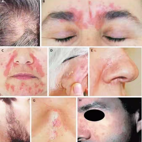 脂溢性皮炎的罪魁祸首是真菌，还可能与这几点有关