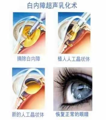 免费摘除白内障，时机把握很重要！