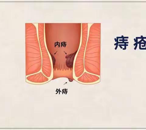 痔疮是怎么引起的？治疗痔疮要避免的5大因素