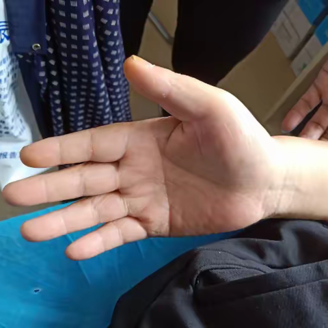 症状表现差不多，是不是得了“渐冻症”呢？合理的鉴别诊断很重要！