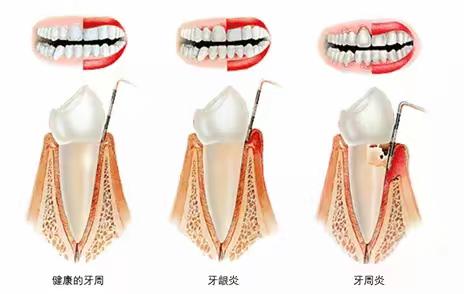 不容忽视的牙周炎