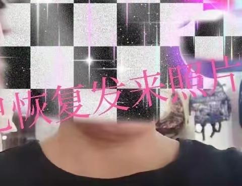 痉挛性斜颈这样治，时间没浪费