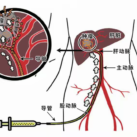 治疗肝癌的“黑科技”：肝动脉化疗栓塞（TACE）介入治疗