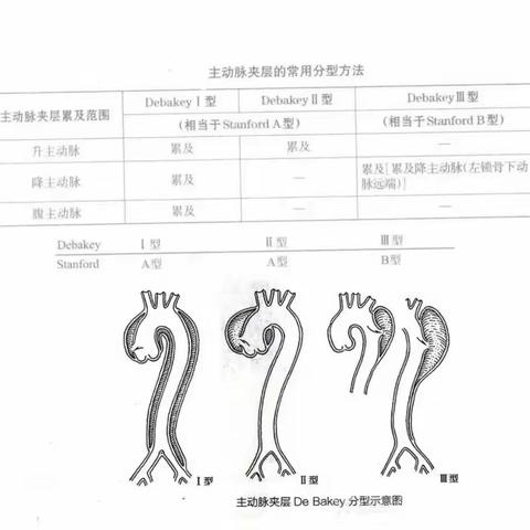 主动脉夹层诊疗要点总结