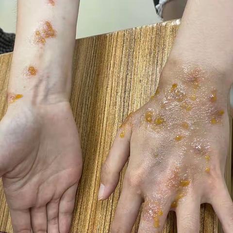 湿疹，是因为太湿吗