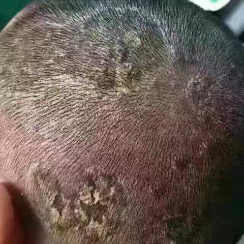 头癣的健康教育