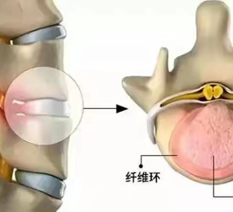 【专家谈健康】每日科普——腰椎间盘突出症