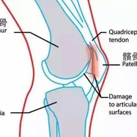 如何诊治髌骨软化症比较好