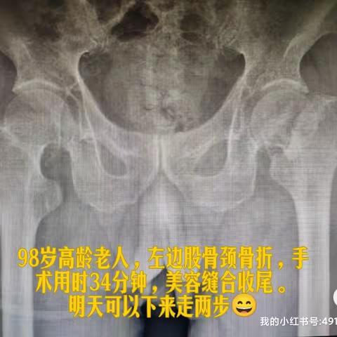 98岁的老人，一跤摔得可不轻，回南天注意防滑！！